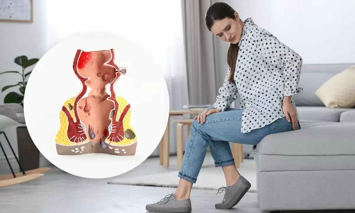 Kvinna med obehag som visar en modell av ändtarmen med hemorrojder och blod.