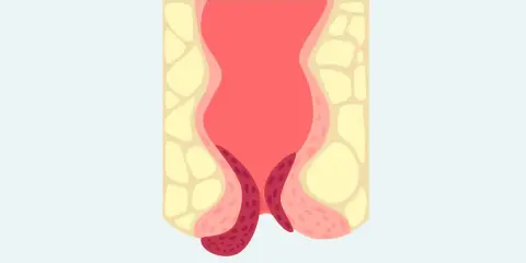 Illustration av ändtarmen med synliga hemorrojder. Hur vet man om man har hemorrojder? Blödning eller klåda kan vara tecken.
