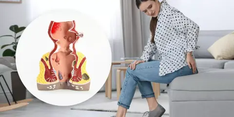 Kvinna med obehag som visar en modell av ändtarmen med hemorrojder och blod.