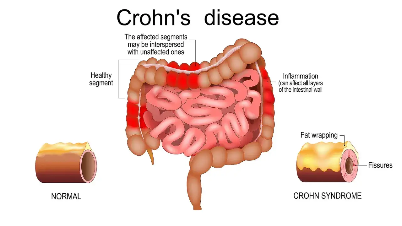 Illustration av Crohns sjukdom som visar inflammerade tarmsegment och 
